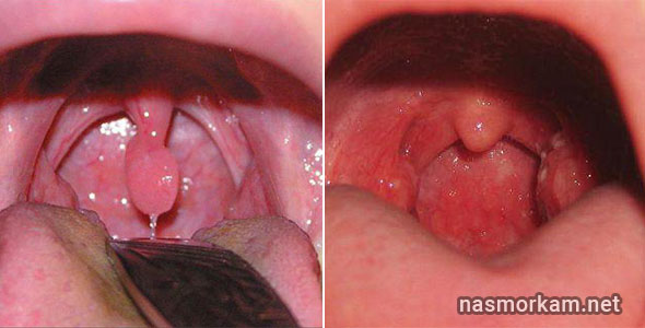 Лечение опухшего язычка в горле